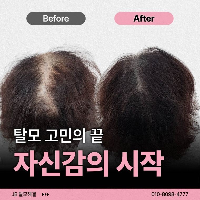 제이비탈모해결